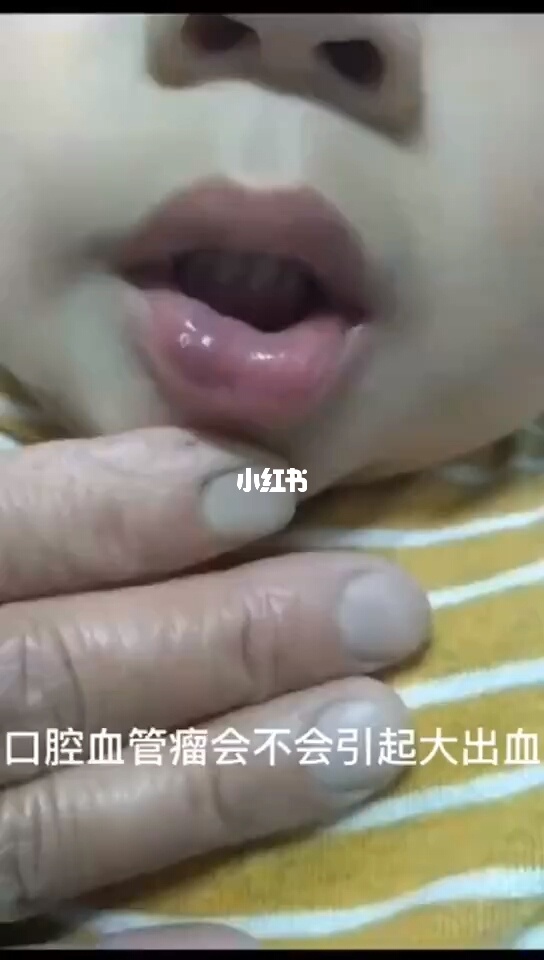 门静脉癌栓 索拉非尼_索拉非尼 说明书_索拉非尼治疗卵巢癌有效吗