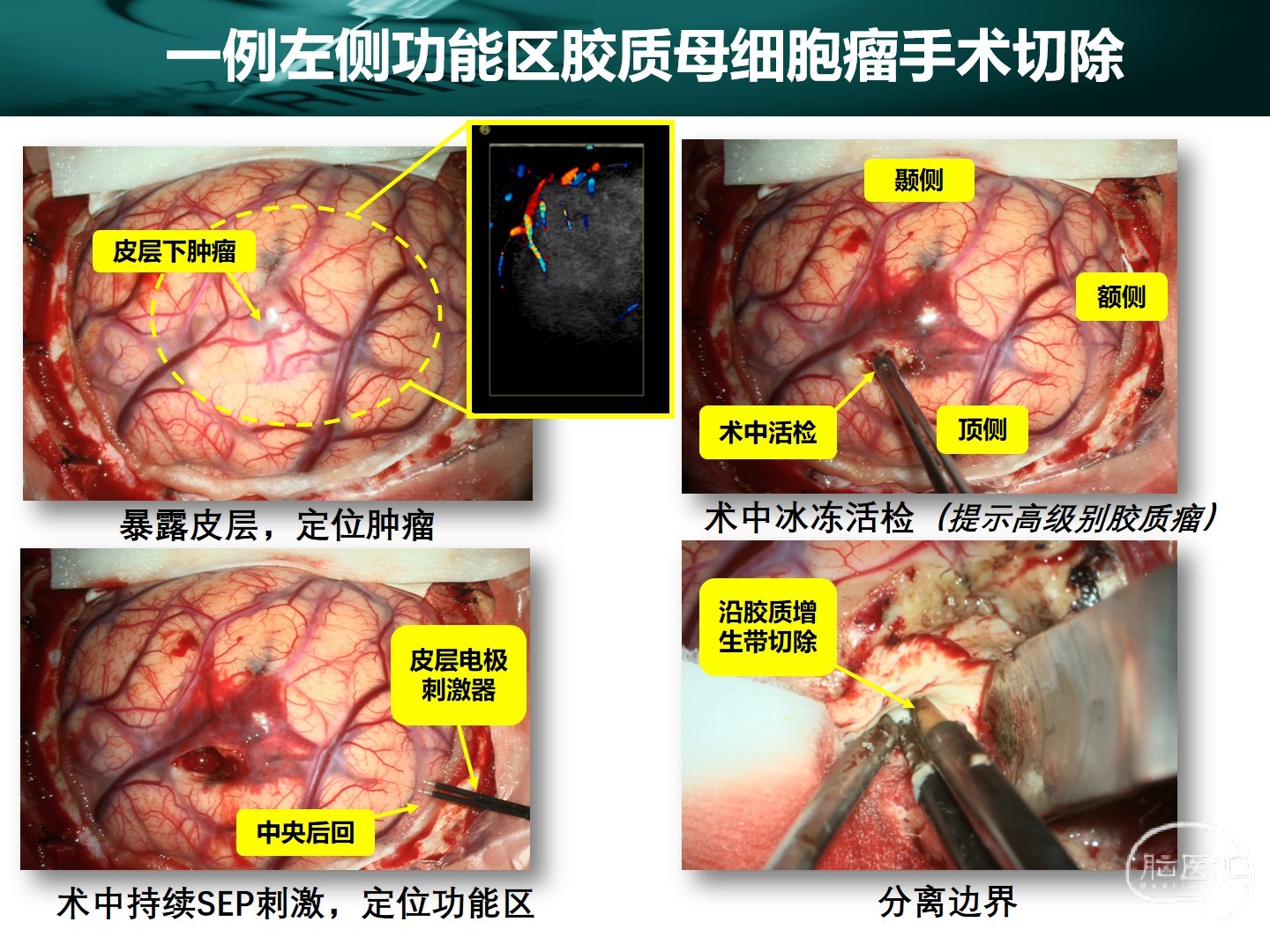 贝伐珠单抗注射液_贝伐珠单抗不良反应_贝伐单抗治理胶质瘤