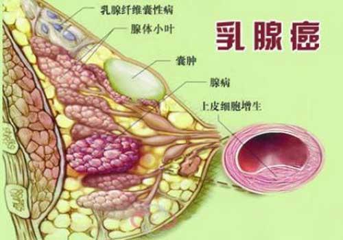 首届中国进展期乳腺癌共识指南（草案）的临床研究