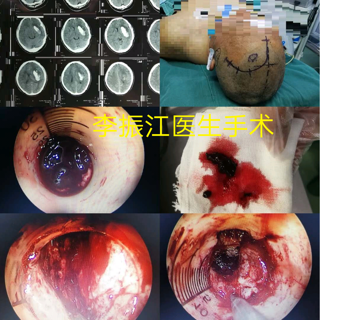 贝伐珠单抗联合不同化疗方案治疗单抗注射液不良反应