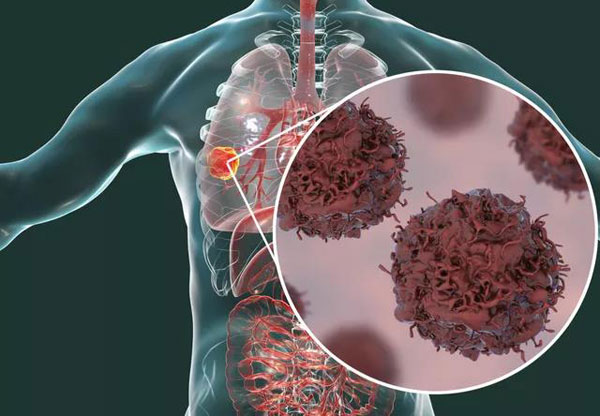 广东省教授：让肺癌成为可用药物控制的慢性病！！