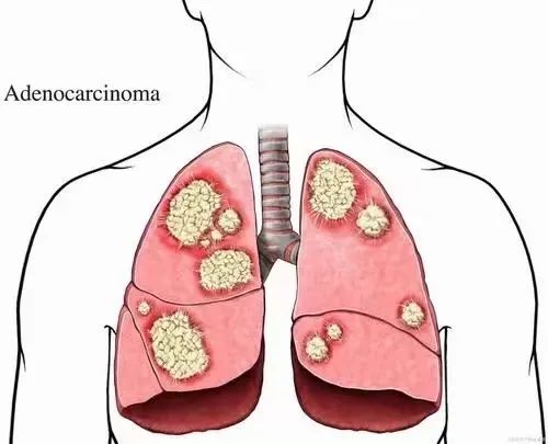 EGFR突变肺鳞状细胞癌的一种有前途的治疗选择？
