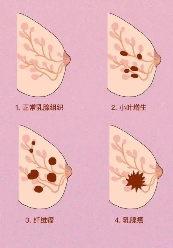 贝伐单抗对右侧结肠癌有效吗_贝伐单抗耐药性_贝伐珠单抗是化疗吗