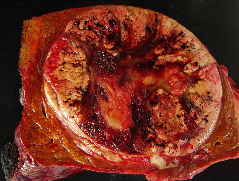 肝癌吃索拉非尼的效果_肝癌转移到肺吃索拉非尼_索拉非尼 肝癌