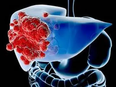 肝癌转移到肺吃索拉非尼_索拉非尼 肝癌_肝癌吃索拉非尼的效果