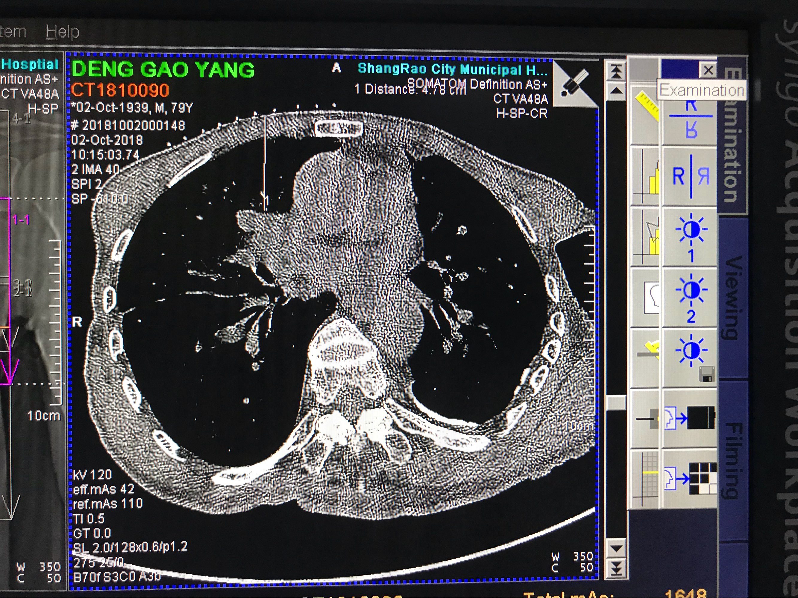 肺鳞癌和腺癌哪种好治_肺腺癌需要吃吉非替尼_肺早期原位腺癌