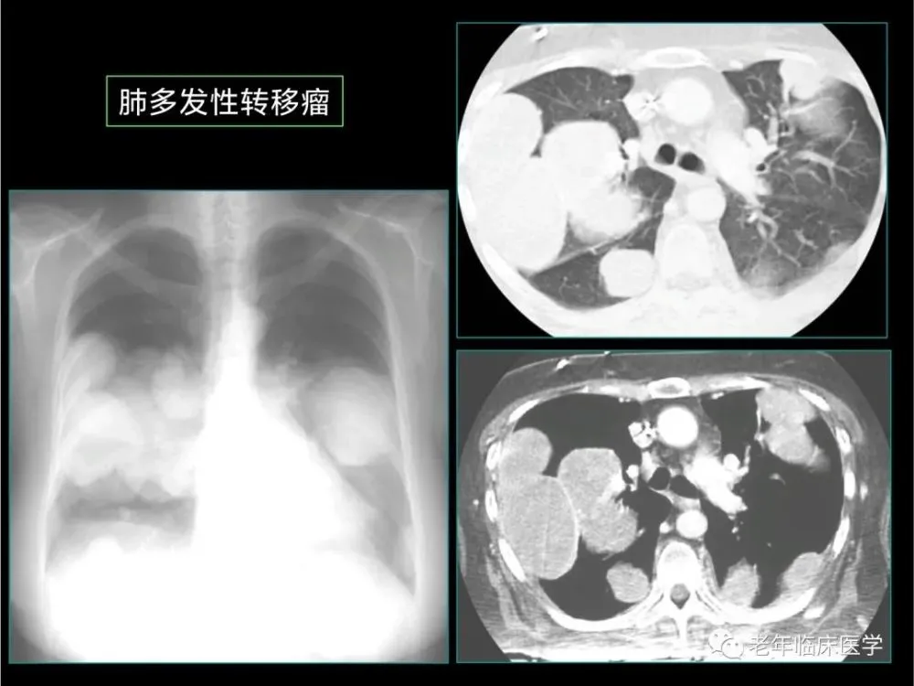 肺癌晚期骨转移盲吃药后骨头不疼现又疼_86岁