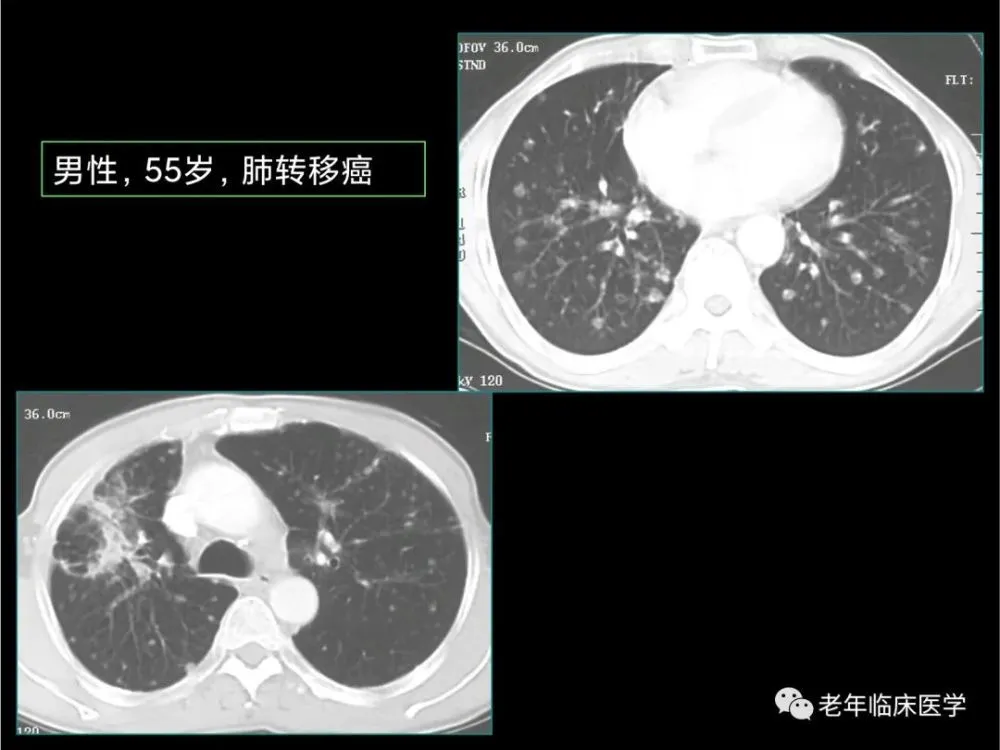 吃吉非替尼易瑞可多久没皮疹_吃罗红霉素皮疹图片_皮疹什么药膏没激素