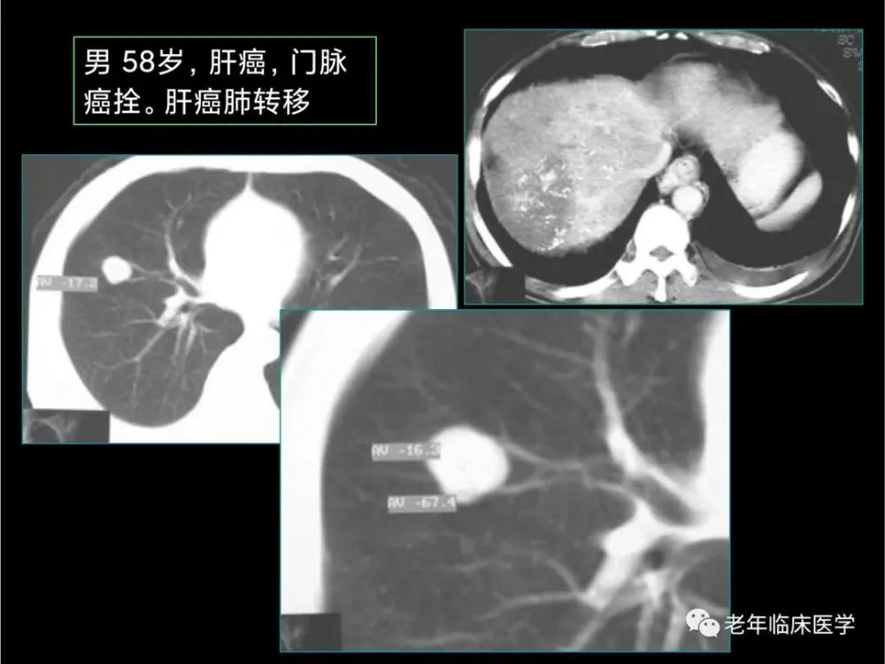 吃吉非替尼易瑞可多久没皮疹_皮疹什么药膏没激素_吃罗红霉素皮疹图片