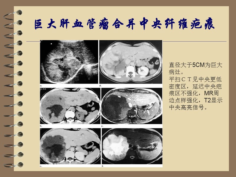 贝伐珠单抗是化疗药吗_贝伐珠单抗可以报销吗_贝伐单抗用于黑色素瘤转移肺部