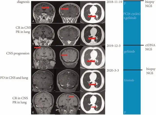 奥希替尼治疗方案治疗肺癌脑转移癌效果的确不错