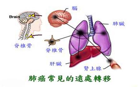 去哪买印度版奥希替尼_奥希替尼造成心衰_奥希替尼9291