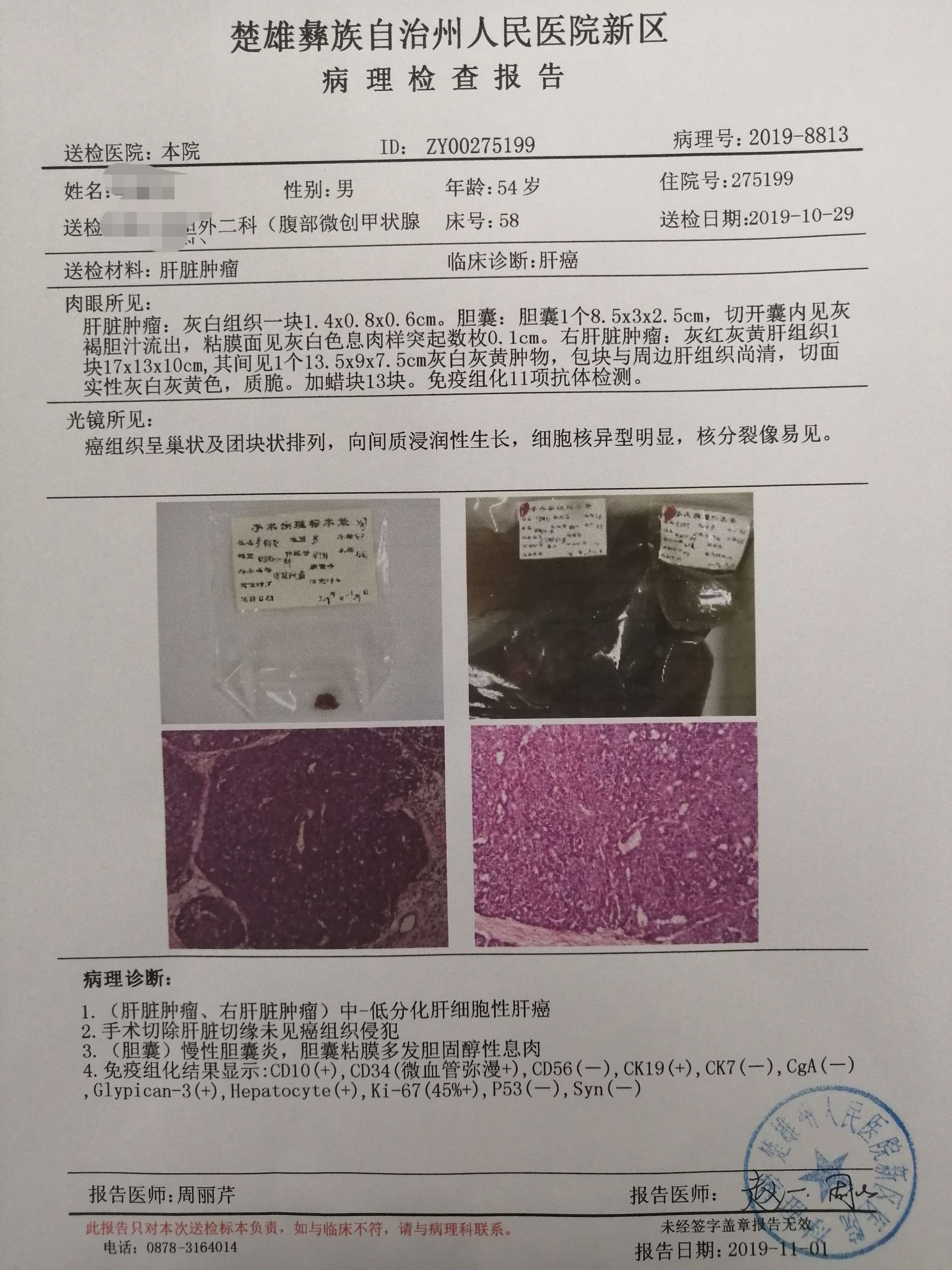 肝癌靶点分子靶向药物试用于治疗晚期肝癌多种药物