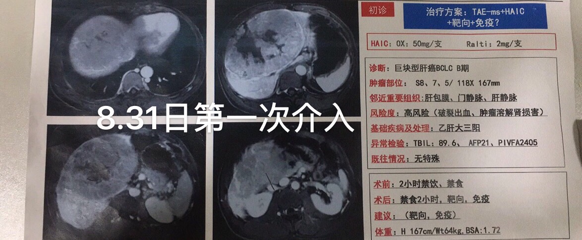 乐伐替尼耐药后吃索拉非尼行吗_奥希替尼耐药后第四代靶向药_吃索拉非尼效果怎么样