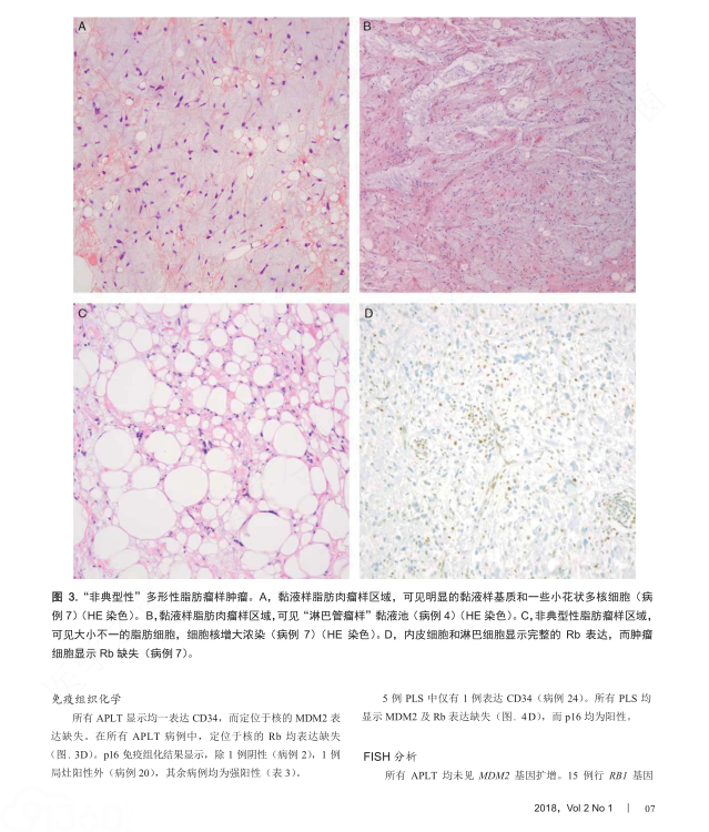 脑瘤注射贝伐珠单抗有效果吗_贝伐珠单抗治疗肺腺癌_贝伐单抗和贝伐珠单抗