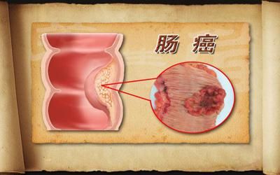 贝伐单抗和贝伐珠单抗_贝伐珠单抗肠癌晚期_贝伐单抗能治好直肠癌