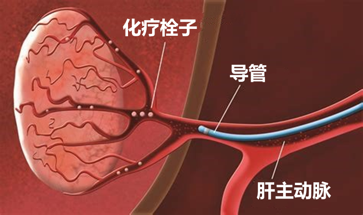 索拉菲尼联合介入对晚期肝细胞癌的治疗选择