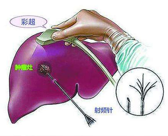 索拉非尼 裸鼠肝癌_肝癌介入治疗后吃索拉非尼_索拉非尼 肝癌