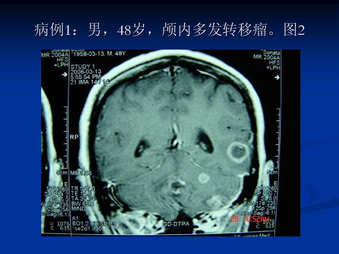 阿帕替尼逆转耐药_吉非替尼耐药后ct表现_克唑替尼耐药时间