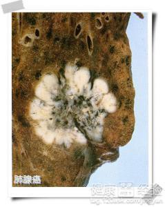 奥希替尼对小细胞肺癌有用吗_奥希替尼多少钱一盒_阿斯利康 奥希替尼