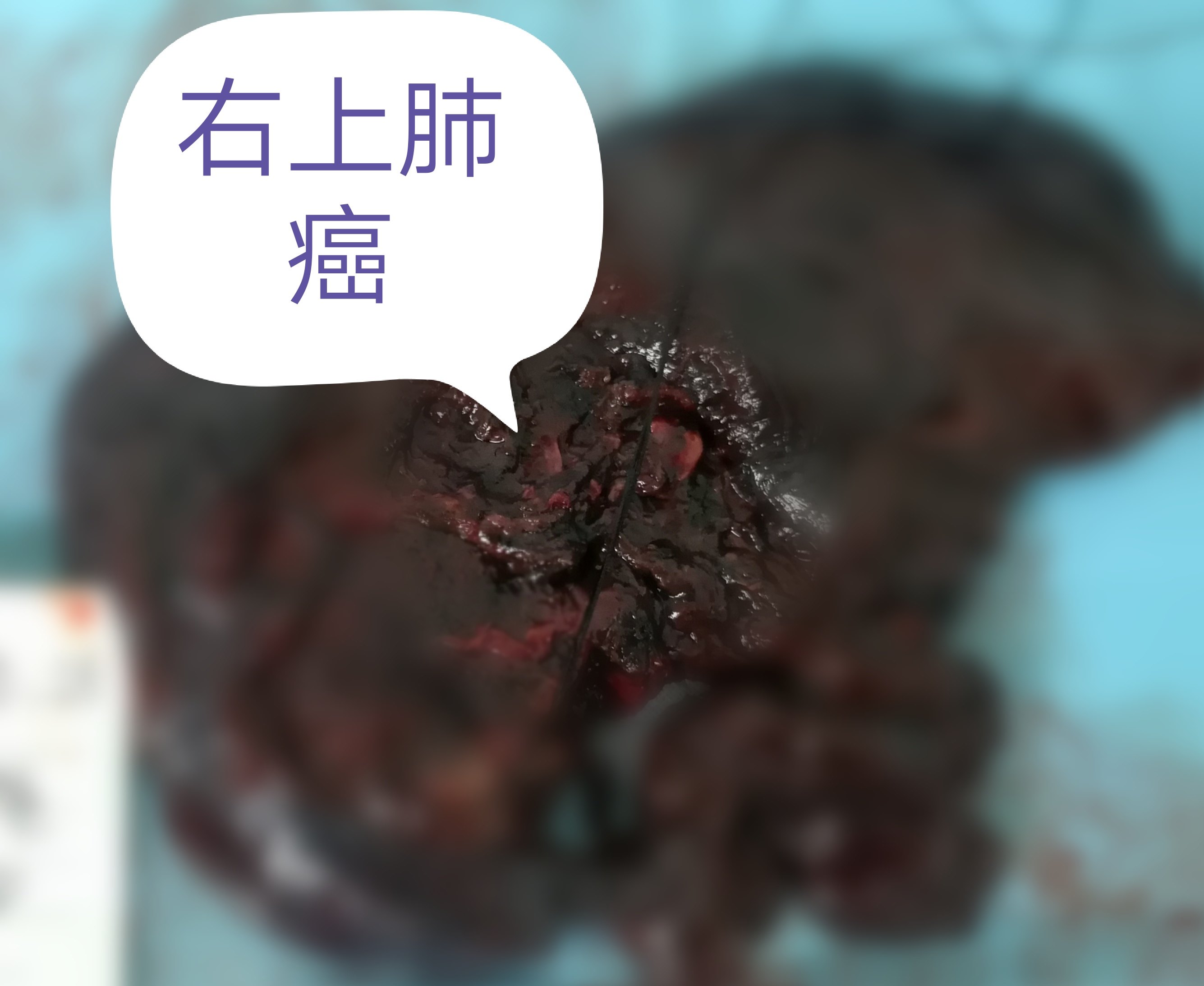 乳癖消片治甲状腺结节吗_盐酸替扎尼定片治啥病_吉非替尼片治肺结节