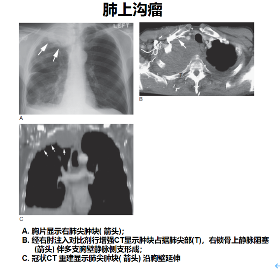 肝癌靶向药索拉非尼_肺癌骨转移吃靶向药_靶向药吉非替尼吃过有什么反应