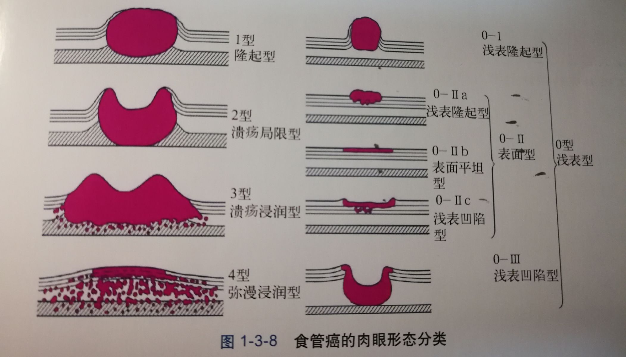 食道喷门癌 上海哪家医院比较好_佛尼吉吉亚_食道癌吉非替尼