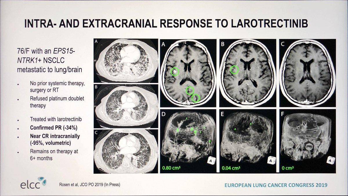 厄洛替尼、吉非替尼靶向治疗非小细胞肺癌脑转移