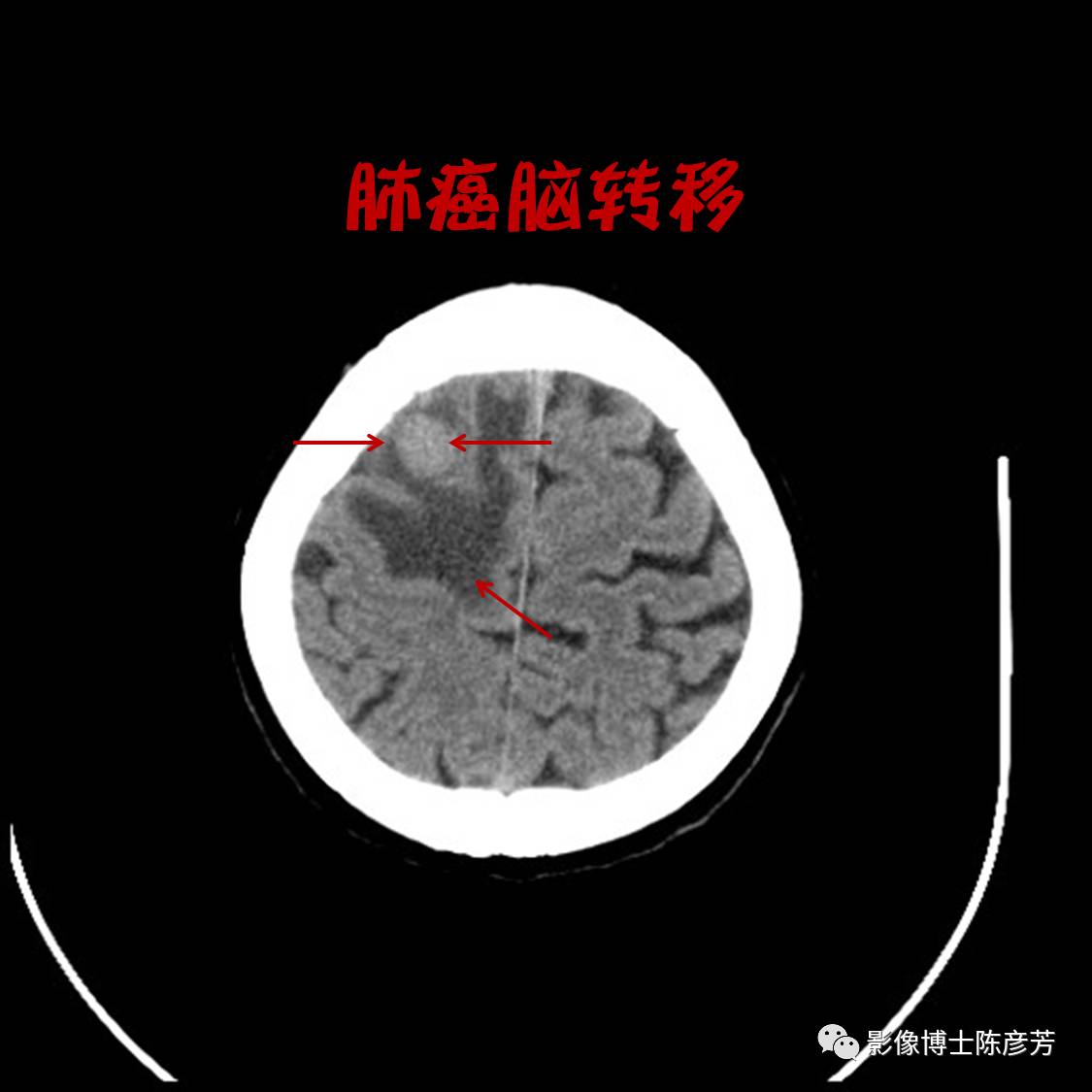 印度舒尼替尼怎么服用_服用吉非替尼脑转移治疗方法_导管原位癌没有转移需要服用三苯氧胺