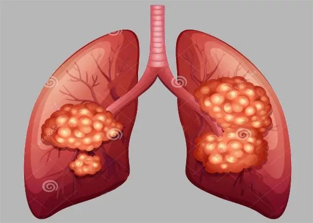 一下印度的吉非替尼对肺腺癌有用吗？研究选择30例肺癌患者