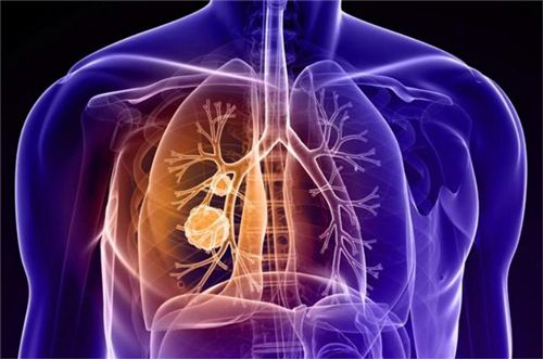 贝伐珠单抗联合化疗破局晚期肺癌患者治疗困境（IV）