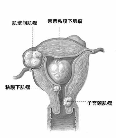肺癌患者可以吃海参吗_肺癌患者可以吃桃胶吗_吉非替尼肺癌患者吃头痛吗
