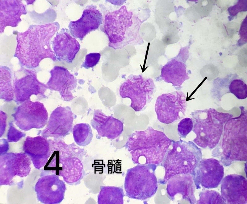 肺腺癌吃奥希替尼全身痒_吃螃蟹过敏 全身痒 怎么办_奥斯替尼和奥希替尼