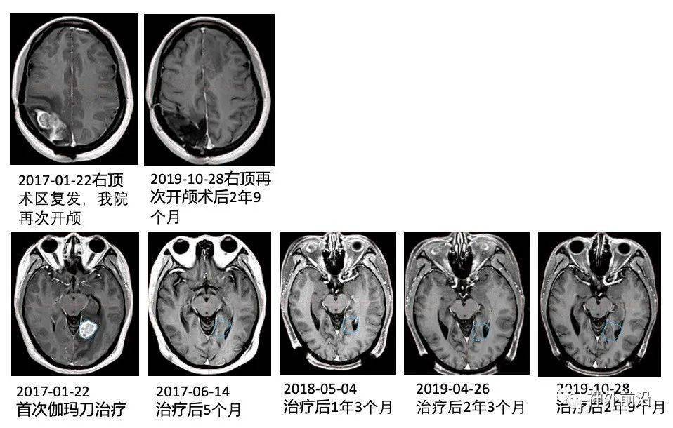 ESMO尼将总人群疾病进展或死亡风险显着降低46%