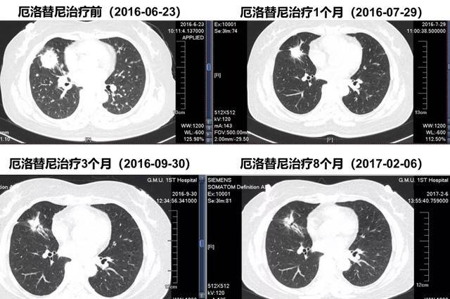 奥希替尼9291药品_奥希替尼印度版多少钱_奥希替尼能治疗脑转移吗