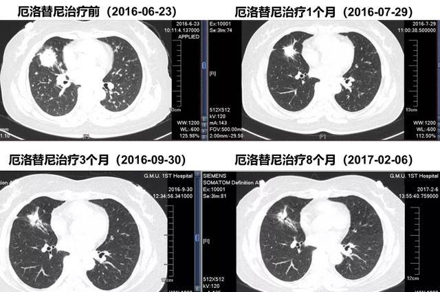 一下奥希替尼治疗脑转移的效果有哪些？-绘佳