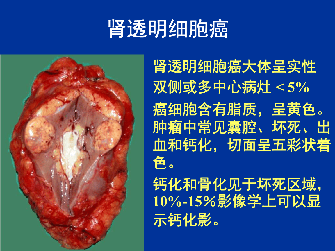 吉非替尼治疗不吸烟的_tap4fun尼毕鲁 杨祥吉_吉内·滕尼