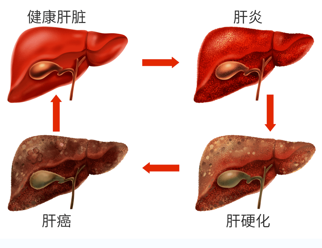 索拉非尼 肝癌_肝癌吃索拉非尼胃口不好_索拉非尼与多纳非尼