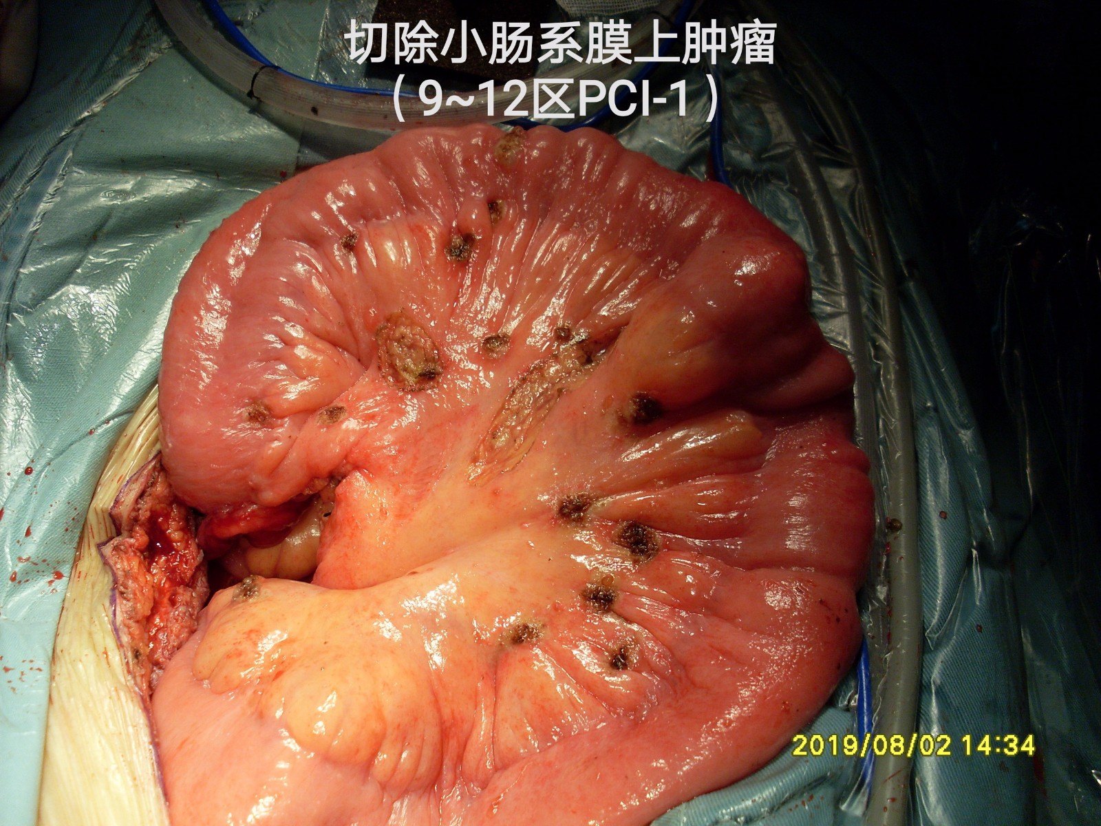 贝伐珠单抗能治脑肿瘤吗_贝伐珠单抗说明书_贝伐珠单抗最新价格