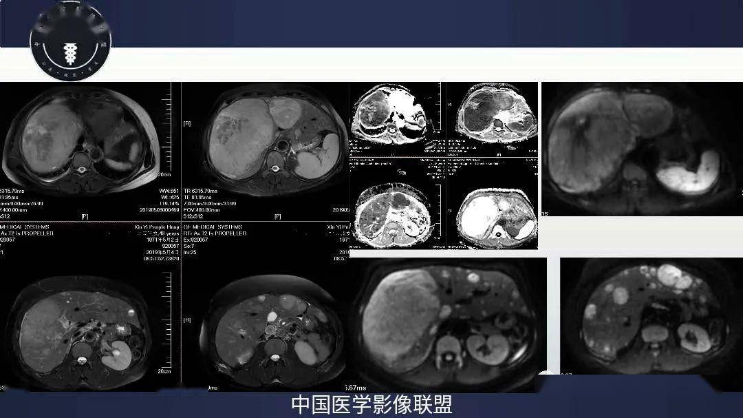 分子靶向治疗遵循“精准治疗”理念，进一步提高了肝癌患者生存