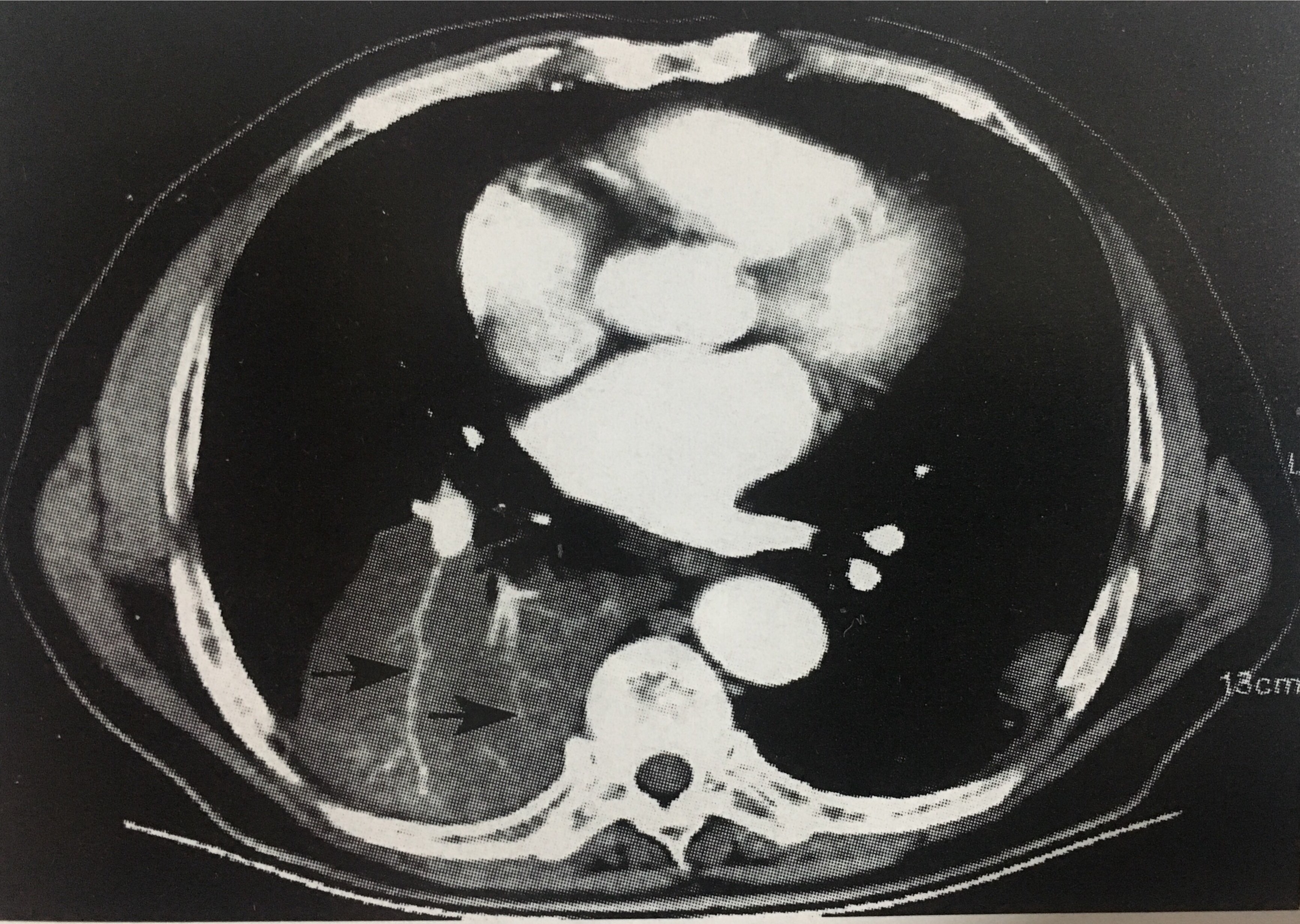 两名突变的转移性肺腺癌患者受益于贝伐单抗联合治疗