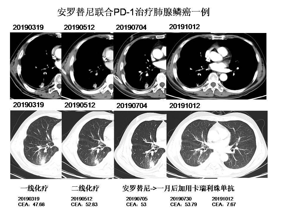 贝伐珠单抗是靶向药吗_结肠癌晚期 贝伐珠单抗_联合贝伐珠单抗价格