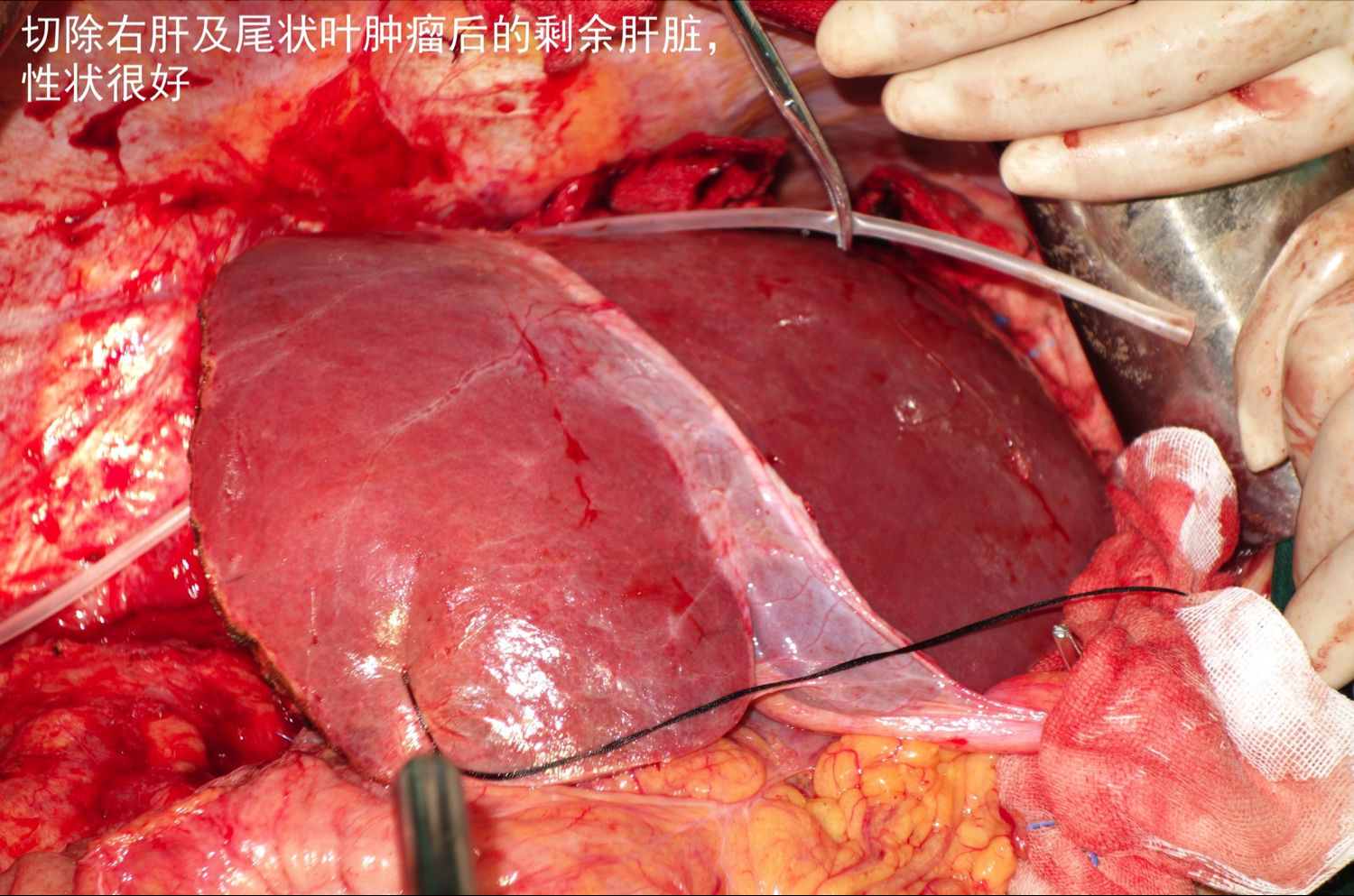 甲状腺乳头状癌不算癌_索拉非尼对甲状腺癌有疗效吗_有国产的索拉非尼