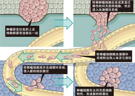 

复发性胶质母细胞瘤对贝伐单抗治疗的反应指标及对比

