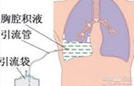 
胸腔积液该怎么治疗呢？吉林79岁老人怎么办