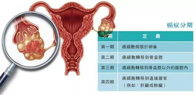 贝伐珠单抗价格_贝伐珠单抗是化疗吗_卵巢癌贝伐单抗一线