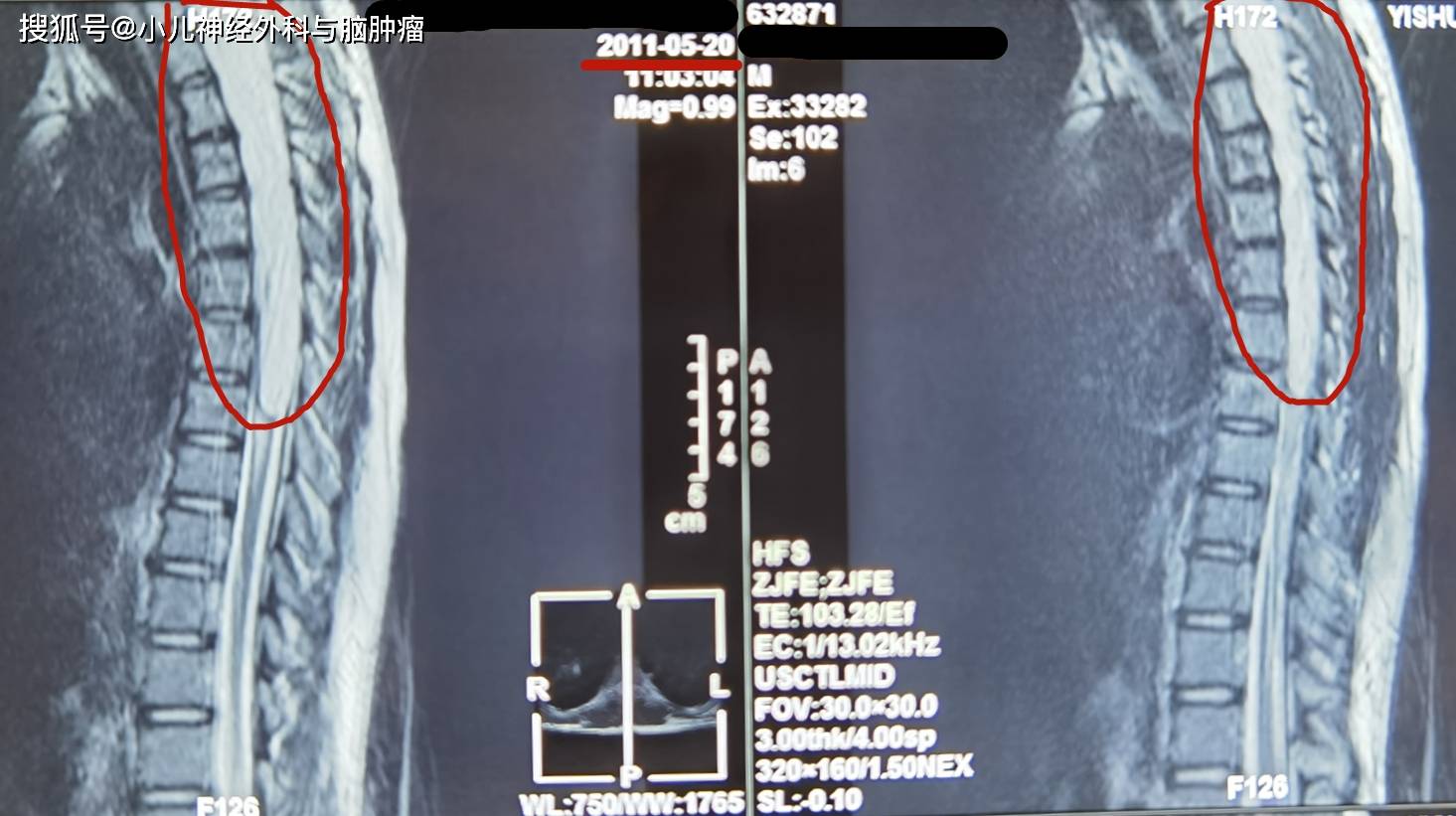 贝伐珠单抗4个月后赠药_贝伐珠单抗不良反应_贝伐珠单抗腹腔注射有效吗