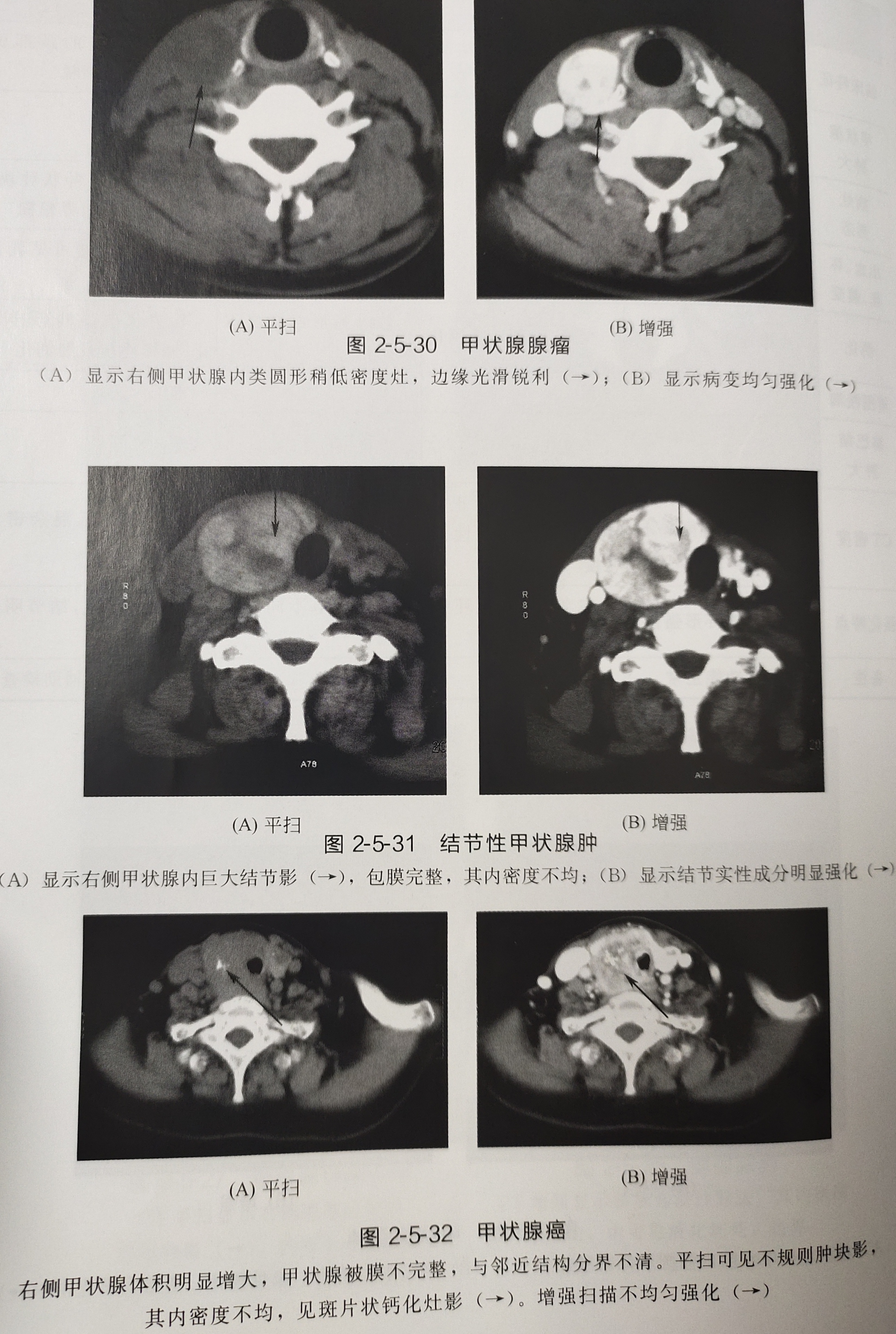 贝伐珠单抗腹腔注射有效吗_贝伐珠单抗不良反应_贝伐珠单抗4个月后赠药