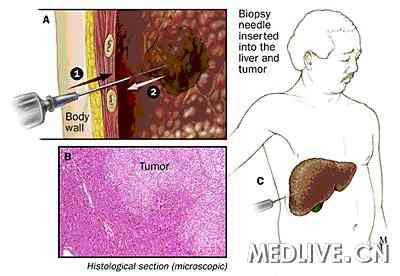 肝癌索拉非尼的功效和作用_索拉非尼 肝癌有效率_肝癌的索拉菲尼