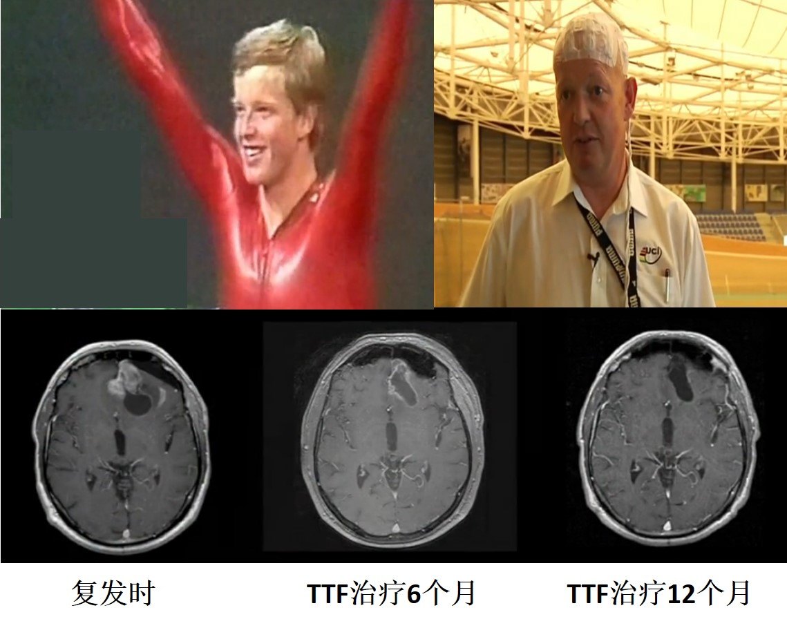 贝伐珠单抗会导致胶质瘤缩小吗_贝伐珠单抗多少钱一支_贝伐珠单抗赠药